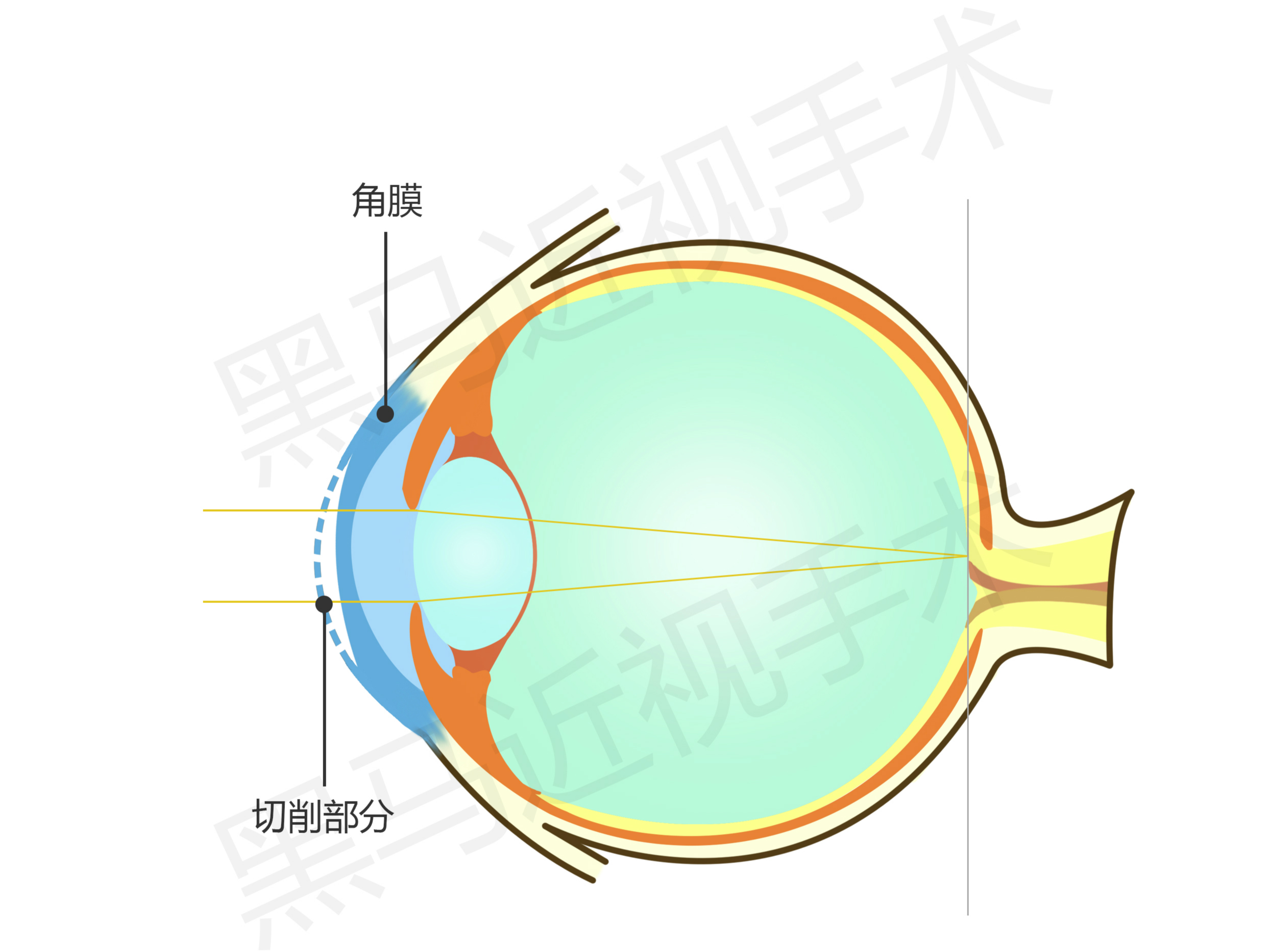 近视手术真实案例分享博主,近视屈光手术亲身经验