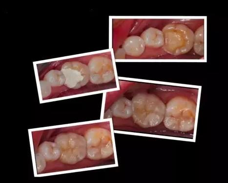 补牙树脂修复牙齿,大连市口腔医院牙齿修复