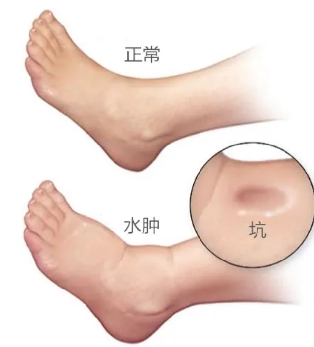 【慎之又肾】经常自我感觉“膨胀”？你可能是肿了