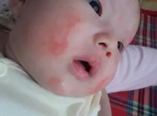 宝宝长湿疹到底怎么办,宝宝湿疹是因为妈妈上火吗