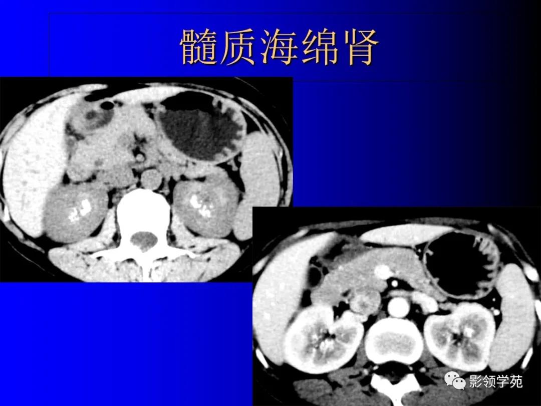 肾脏囊性肿块的影像学特点,肾脏典型病理图片及解析