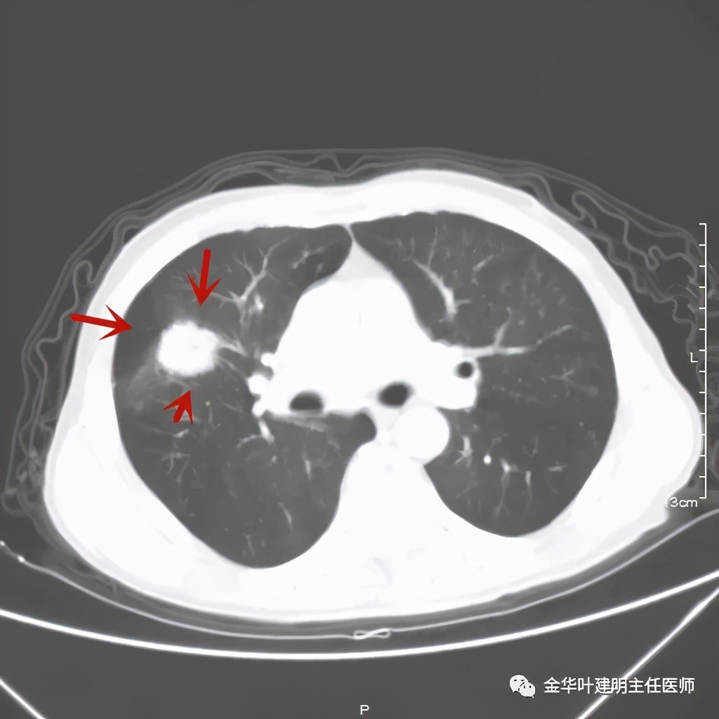 得了肺癌做肺部穿刺有影响吗,肺部穿刺可以确诊肺癌吗
