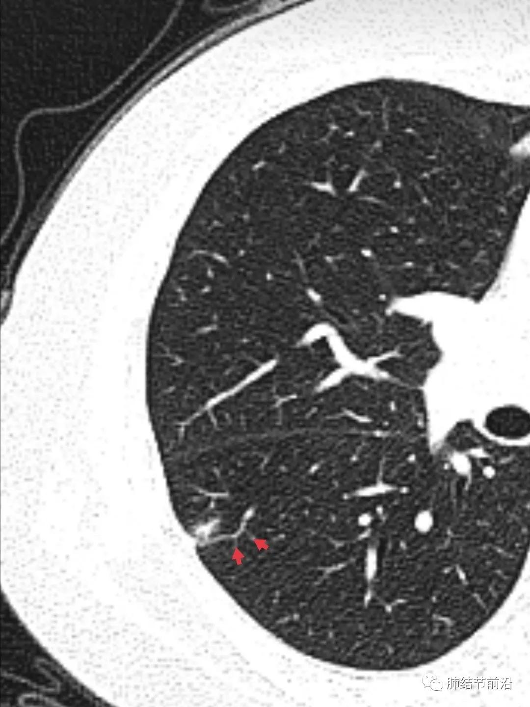 肺部ct肺结节读片教学视频,肺结节读片的专业术语