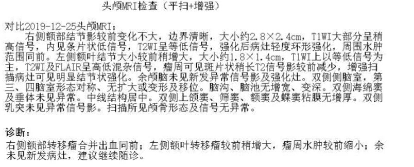 豪森药业阿美替尼治疗厄洛替尼经治T790M+肺腺癌伴脑转移病例分享