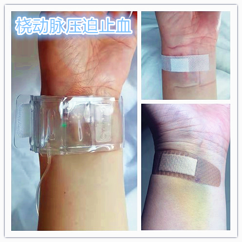 子宫肌瘤介入栓塞术排出黄水,子宫肌瘤介入消融治疗