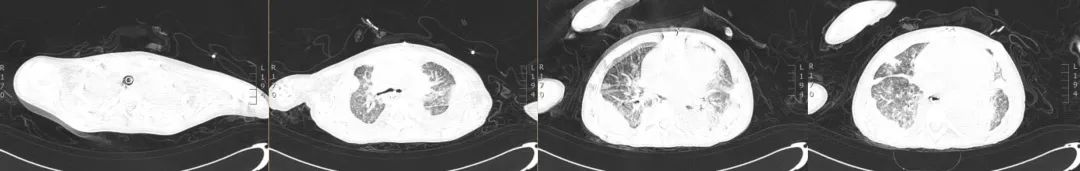 不敢咳嗽如何进行有效排痰,无咳嗽呼吸困难