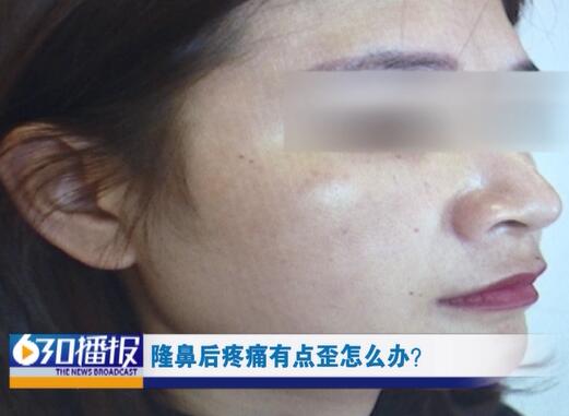 隆鼻后有点歪多久能去修复,刚做完隆鼻是歪的怎么补救