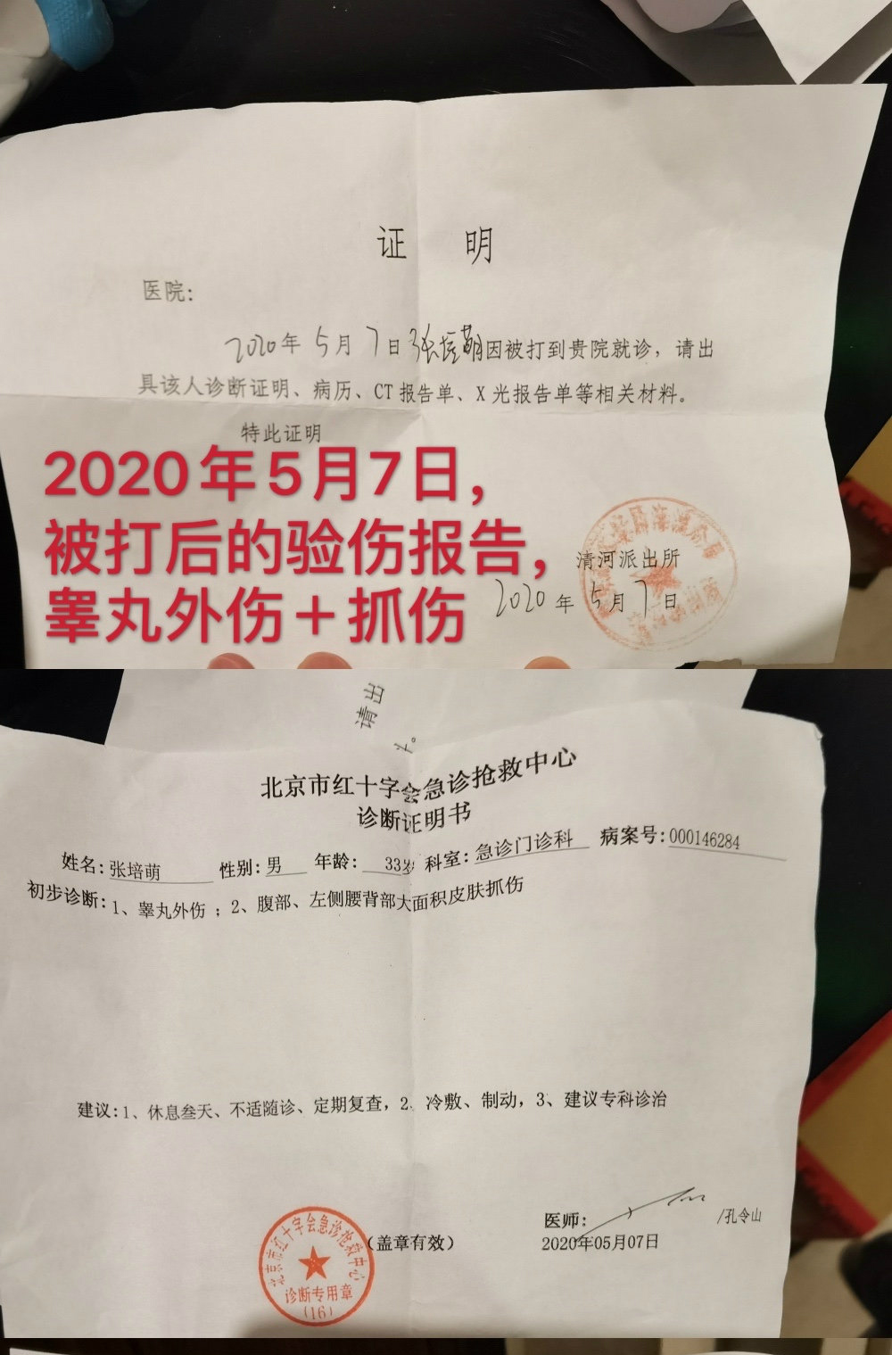 女方指甲折断，男方蛋蛋抓伤，张漠寒张培萌互指家暴，细节揪心