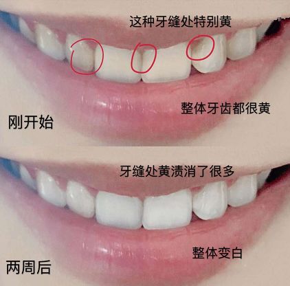 刘涛是全口瓷牙,演员刘涛的一口烤瓷牙多少钱