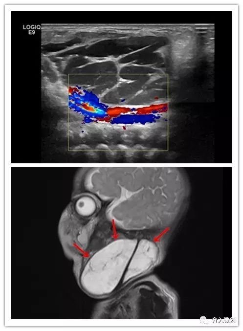 淋巴管畸形硬化治疗费用,静脉畸形硬化的最佳治疗方法