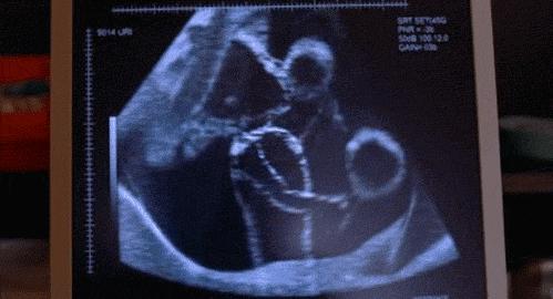 胎位不正乾坤大挪移,乾坤大挪移孕妇