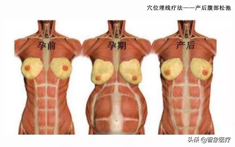 产后腹部紧致按摩手法教程,产后修复穴位埋线