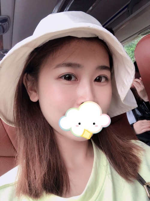 修志夫做双眼皮效果怎么样,修志夫双眼皮修复