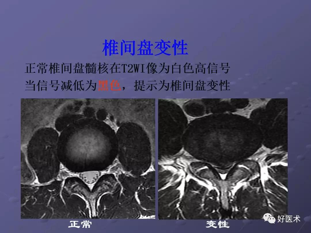 脊柱mri有哪些特点,乳腺疾病的mri诊断及鉴别