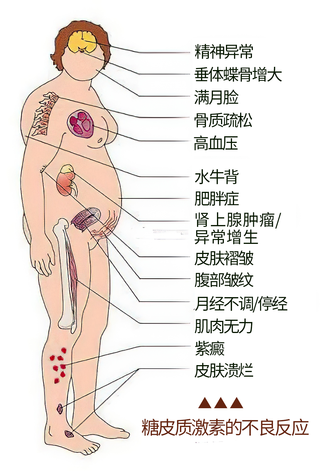 雷公藤治疗类风湿最好药,雷公藤是不是治风湿的