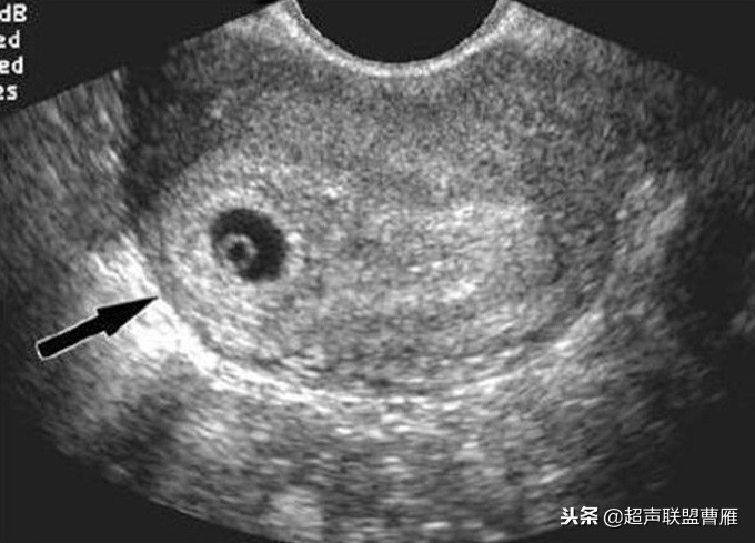 3毫米卵黄囊未见胎芽正常么,40多天的卵黄囊