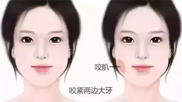 星肉瘦脸针进口与国产哪个便宜,打瘦脸针进口还是国产