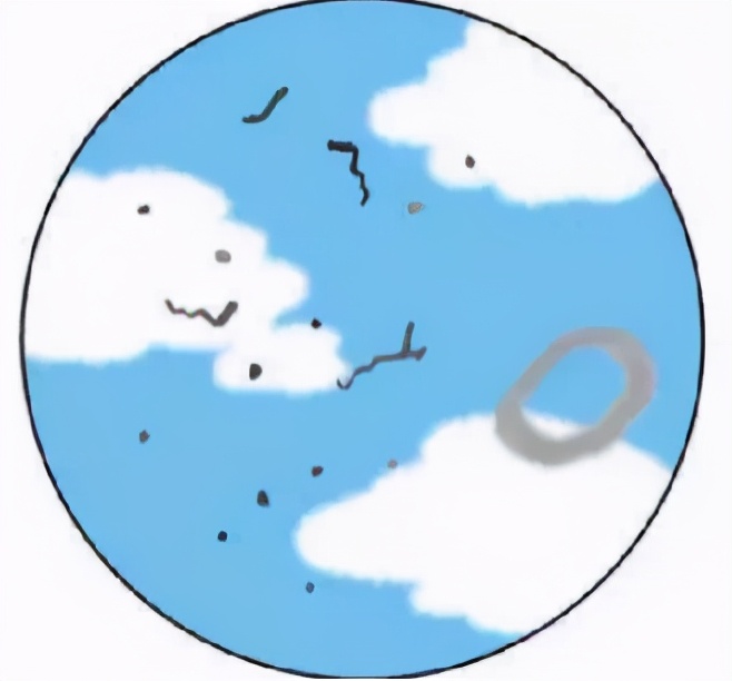 眼前有黑影治得好吗,眼前有小黑点飘动需治疗吗