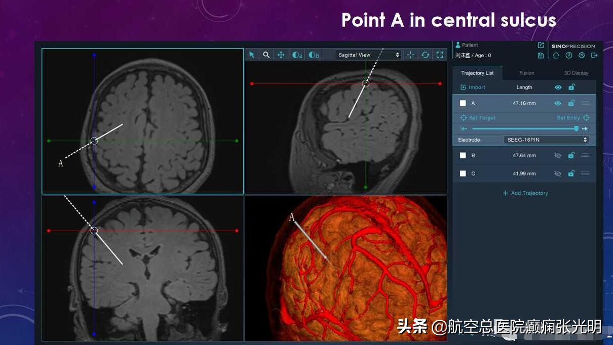 张光明左颞叶癫痫手术成功率,张光明谈治疗癫痫的方法有哪些