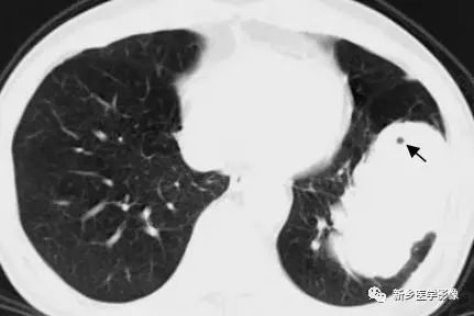 肺部基础免疫,肺基础疾病有哪些