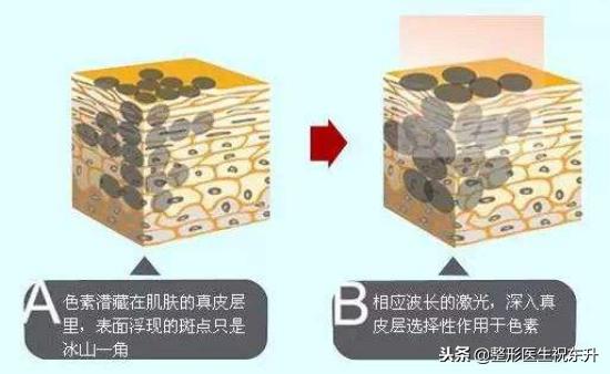 激光祛斑后反黑可以用生长因子吗,激光祛斑后反黑可以涂维生素e吗