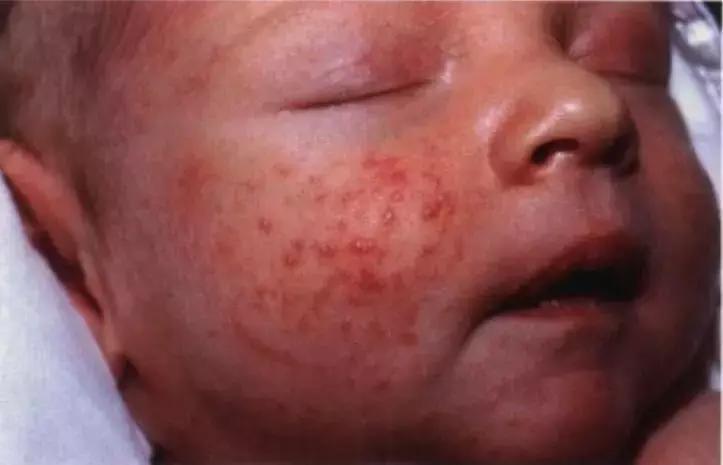 当医生问病人怎么打算时该怎么回,疮疡病病人的症状