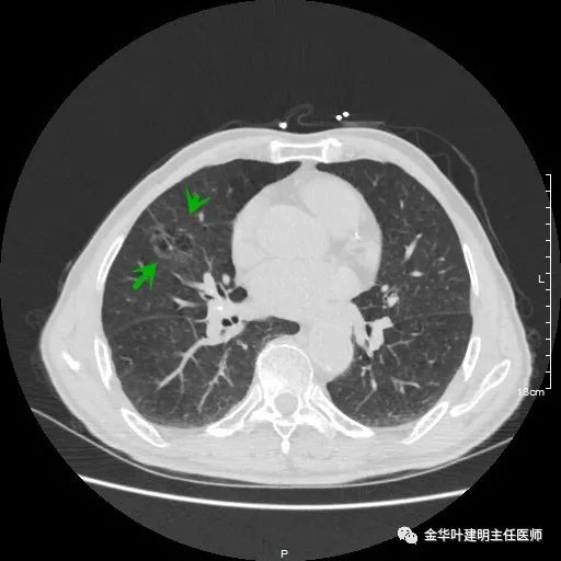 多发原发肺癌能根治吗,肺部原发性恶性肿瘤好治