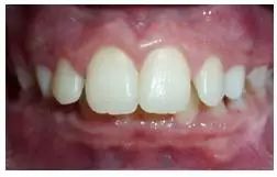 4岁舌系带过短要不要剪,什么是舌系带短图片