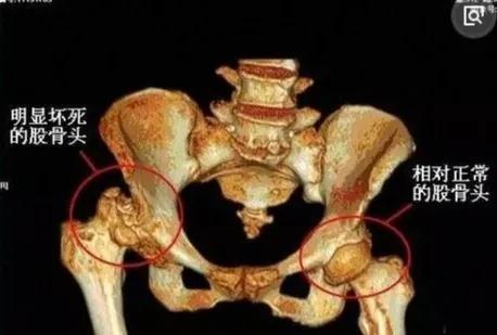 股骨头坏死二三期康复锻炼姿势,二三期股骨头坏死保髋成功率高吗