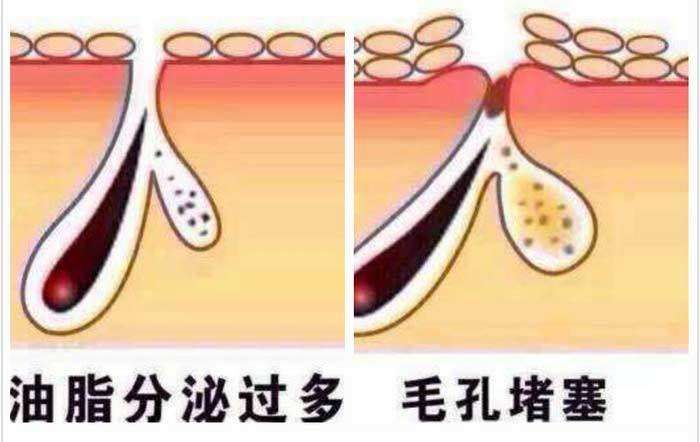 毛囊堵塞脱发推荐什么洗发水,毛囊堵塞引起的脱发解决的方法