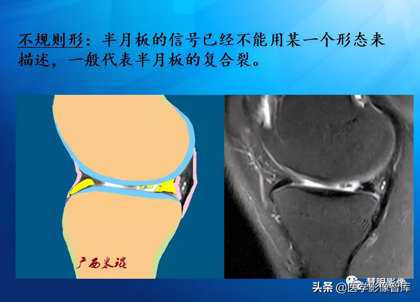膝关节半月板损伤的解剖结构图,半月板mri解剖图解