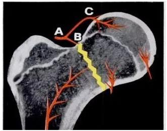 老年人腿粉碎性骨折手术要多少钱,老年人髋骨骨折后一年死亡率