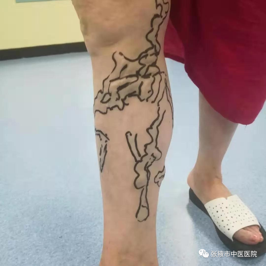 聚桂醇治疗静脉曲张护理操作,张掖市医院下肢静脉曲张微创手术