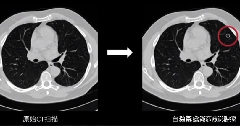 经历3次癌症手术的报道,经历两次肿瘤化疗
