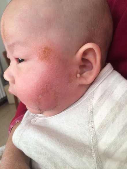 宝宝湿疹严重反反复复怎么办,宝宝湿疹反反复复一直不好怎么办