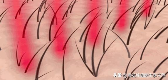 遗传性脱发的症状,遗传性脱发的原因