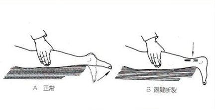 跟腱断裂的早期症状有哪些,诊断跟腱断裂最有效检查方法
