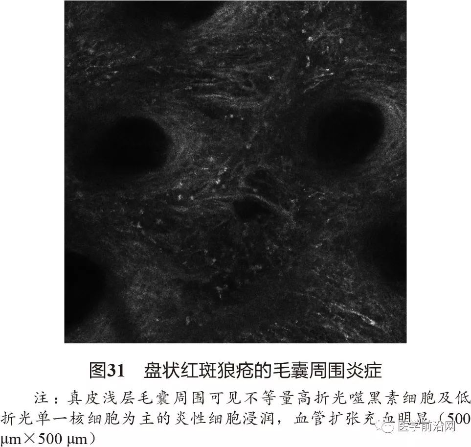 炎症性皮肤病反射式共聚焦显微镜诊断特征专家共识全文发布