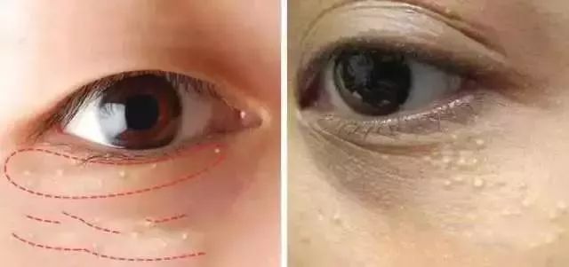 鼻梁和眼睛旁边的小颗粒有救了,鼻梁旁边有小颗粒怎么处理
