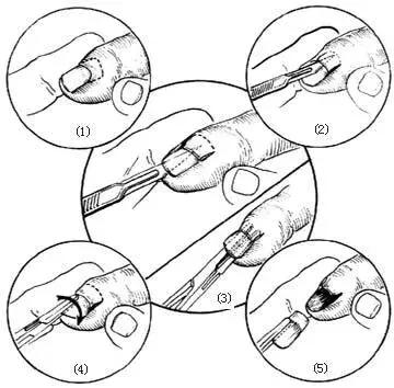 足疗店灰指甲治疗费用大概多少钱,得了灰指甲一个传染俩靠谱吗