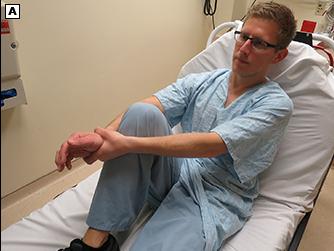 骨科脱臼恢复手法视频,肩膀脱臼骨折保守治疗