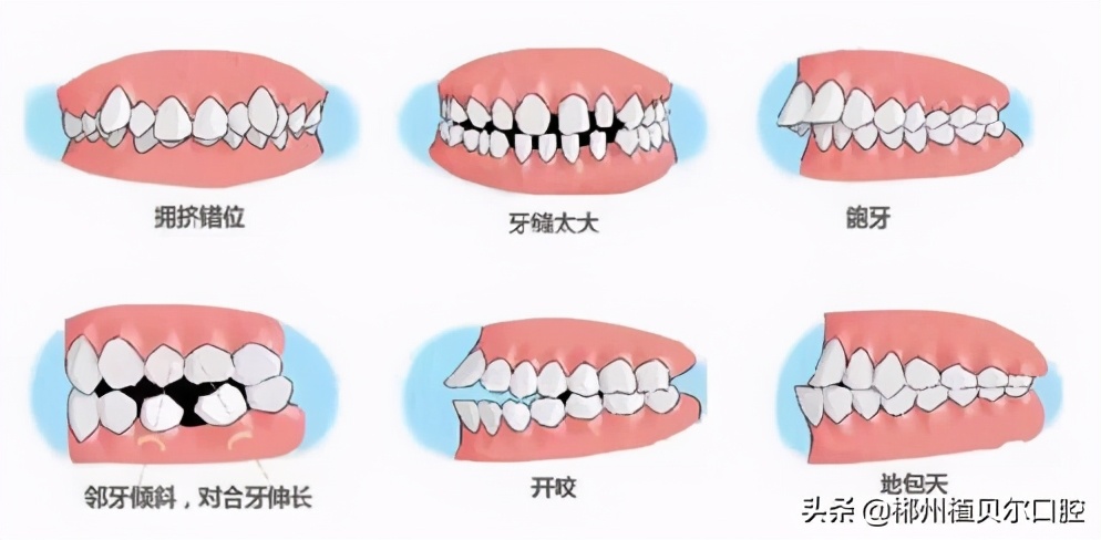 干货牙齿矫正的几个疑问为你解答,牙齿矫正过来人教你怎么避坑