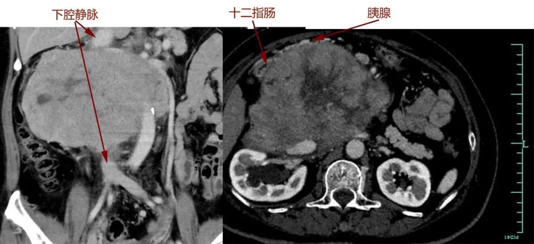 胃口变差,医生从她肚子里取出一个“足球”!疫情之下,这些事千万拖不得!
