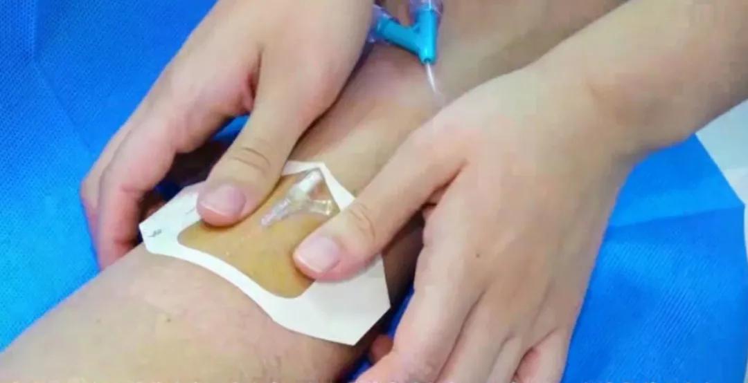 留置针软管断裂有什么症状,留置针的软管断在里面怎么办