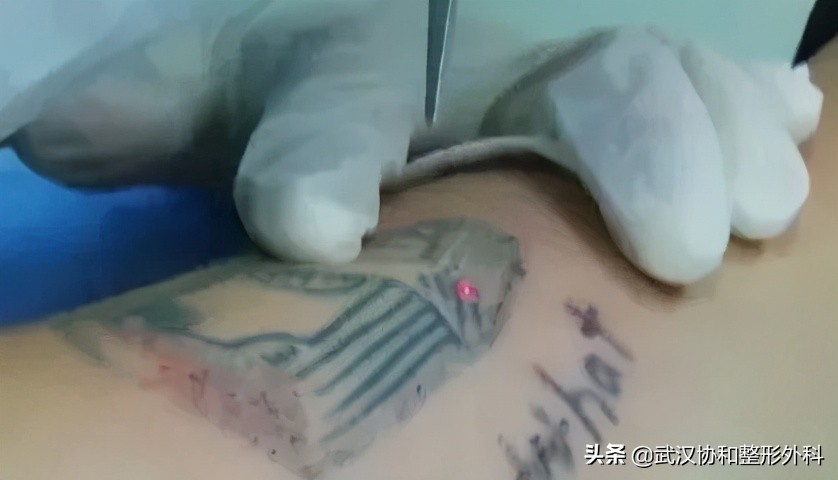 激光洗纹身出血吗,洗纹身是什么体验