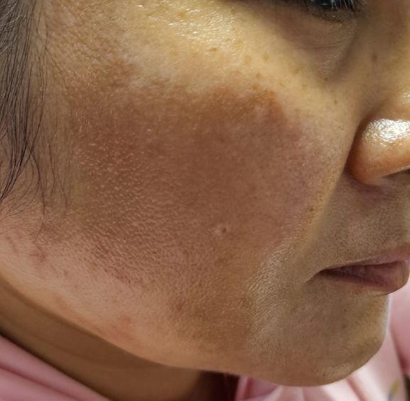 祛斑是真的吗,祛斑的是真的有效还是假的有效