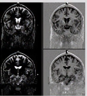 磁共振mri序列参数解读,磁共振mrcp用哪些序列