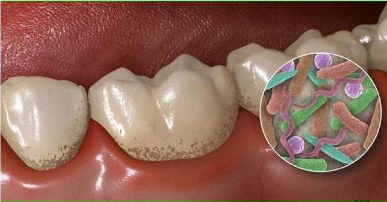 牙釉质损坏有什么补救的吗,牙釉质损坏酸咋办