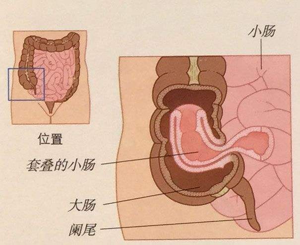 阑尾炎肠套叠等急腹症,婴幼儿肠套叠解决方法