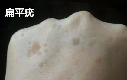 为什么脸上总反反复复长脂肪粒,脂肪粒反反复复怎么办